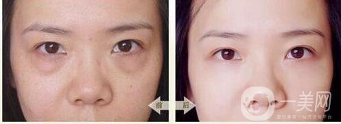 眼周年輕化手術(shù)注意事項(xiàng)