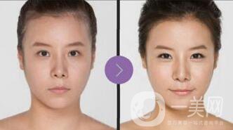 廣東自體脂肪豐面頰價(jià)格