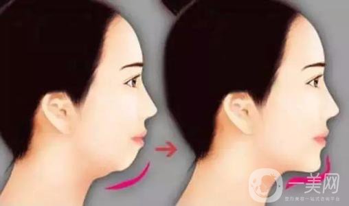 膨體墊下巴有沒有后遺癥？有些什么后遺癥