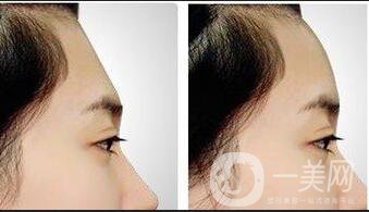 上海額頭自體填充價格