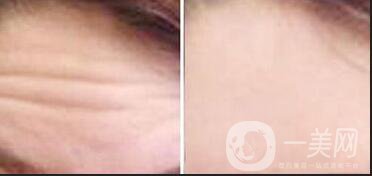 上海去抬頭紋要多少錢