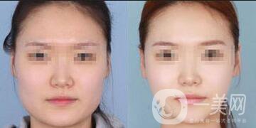 深圳去頰脂墊瘦臉價(jià)格