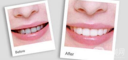 洗牙,洗牙的利與弊