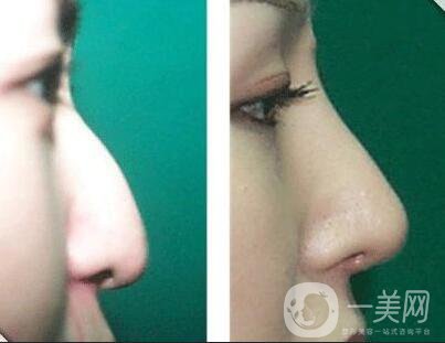 廣東駝峰鼻矯正費用,駝峰鼻矯正費用