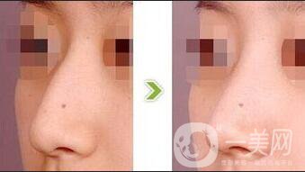 北京鷹鉤鼻矯正多少錢