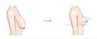 上?？s乳手術(shù)多少錢(qián),縮乳手術(shù)多少錢(qián)