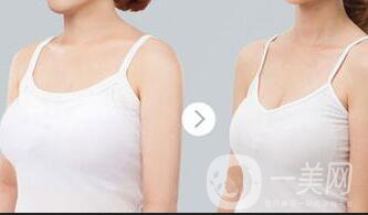 上海縮乳手術(shù)多少錢(qián),縮乳手術(shù)多少錢(qián)