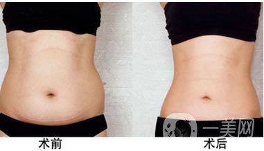 成都水動力溶脂減肥價格介紹一覽