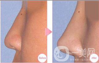 上海耳軟骨隆鼻多少錢(qián),耳軟骨隆鼻,耳軟骨隆鼻多少錢(qián)