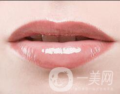 唇腭裂修復術后護理,唇腭裂修復