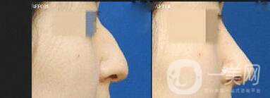 上海鷹鉤鼻矯正價格,鷹鉤鼻矯正價格,鷹鉤鼻矯正