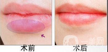 厚唇改薄術(shù)方式