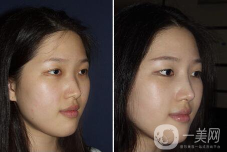 上海肋軟骨隆鼻多少錢,肋軟骨隆鼻多少錢,肋軟骨隆鼻