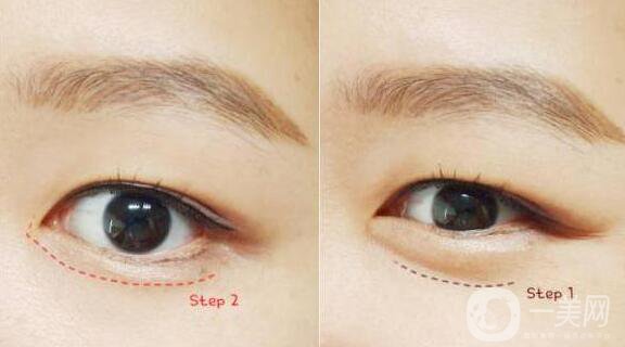 玻尿酸豐臥蠶危害