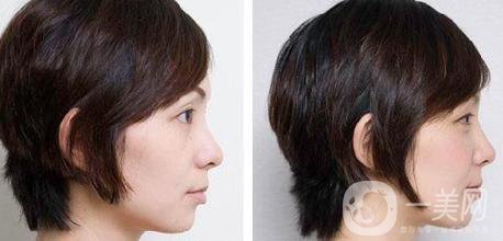 顴弓內(nèi)推手術(shù)主要有什么術(shù)后注意事項(xiàng)