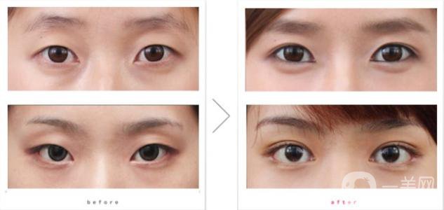 玻尿酸豐臥蠶危害詳細(xì)介紹一覽