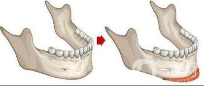膨體墊下巴感染的癥狀有哪些？詳細(xì)介紹一覽