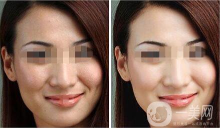 光子嫩膚副作用