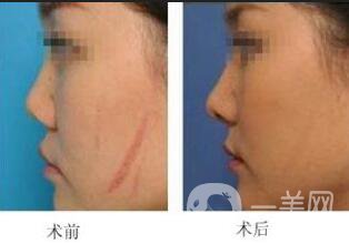 手術(shù)祛疤術(shù)后護理