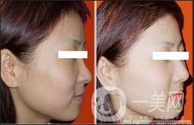 E光嫩膚維持時間