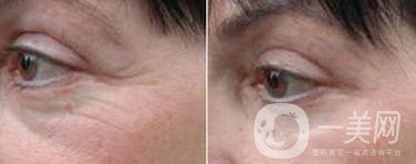 廣東玻尿酸去魚尾紋一般多少錢