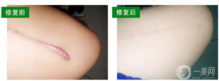 手術(shù)祛疤*果