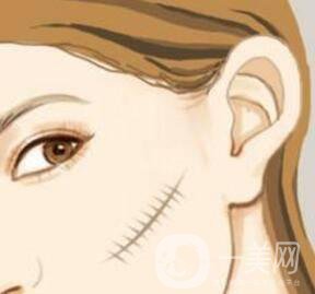 激光祛疤*果怎么樣？有什么優(yōu)勢(shì)