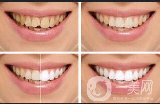 牙齒冷光美白副作用