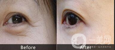 眼部熱瑪吉術(shù)后護(hù)理,眼部熱瑪吉