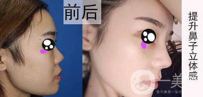 北京肋軟骨隆鼻價(jià)格一般是多少