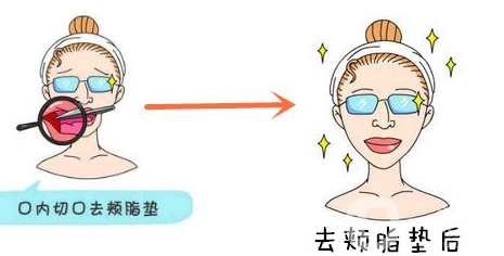 上海去頰脂墊大概得多少錢