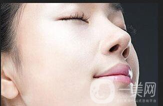 激光去胎記,激光去胎記注意事項