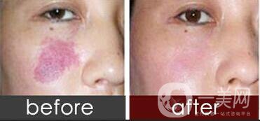 激光去胎記,激光去胎記注意事項