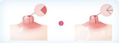 深圳乳頭縮小費用