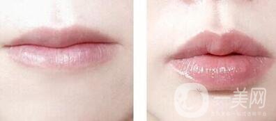 玻尿酸豐唇珠*果