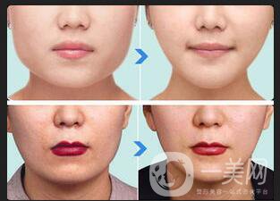 北京激光溶脂瘦臉多少錢,激光溶脂瘦臉多少錢