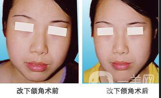 上海下頜角磨骨多少錢