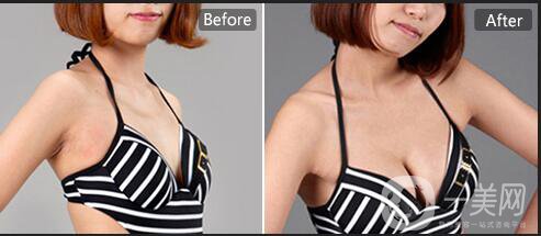 隆胸,隆胸價(jià)錢