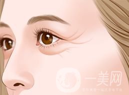 上海自體脂肪去魚(yú)尾紋多少錢(qián)呢？