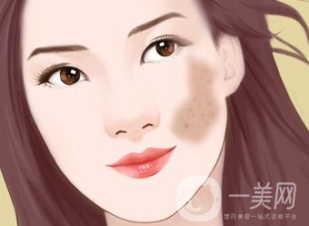 激光去咖啡斑恢復(fù)過(guò)程