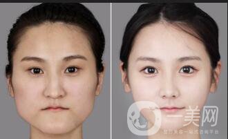 上海下頜角手術(shù)價(jià)格