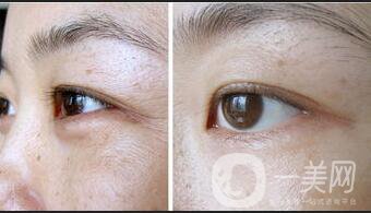 眼部熱瑪吉注意事項