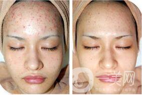 光子嫩膚禁忌癥