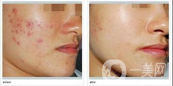 彩光祛痘術(shù)后護(hù)理