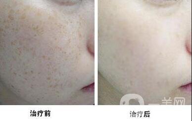 激光去曬斑*果