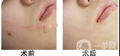 注射祛疤護(hù)理