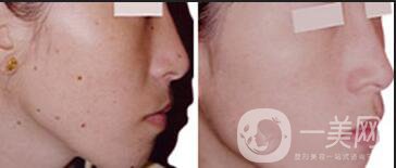 手術(shù)祛痣*果