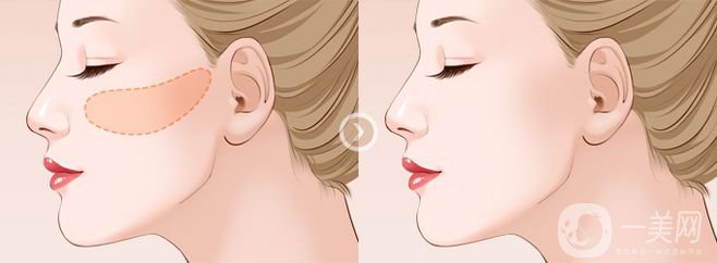 北京顴骨顴弓整形多少錢(qián)