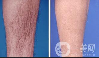 北京光子脫毛價(jià)格