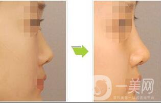 北京朝天鼻矯正多少錢